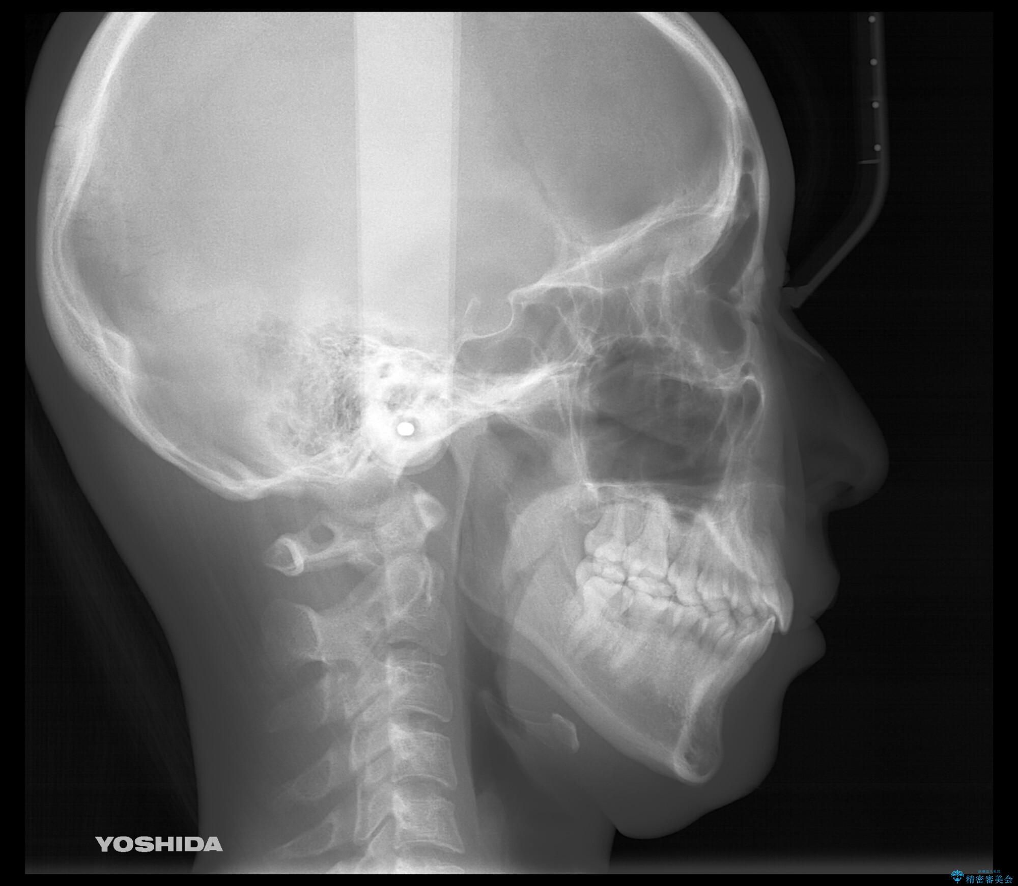 本来は外科ケース:インビザラインで前歯の重度がたつきとオープンバイトの改善の治療後(顔貌)