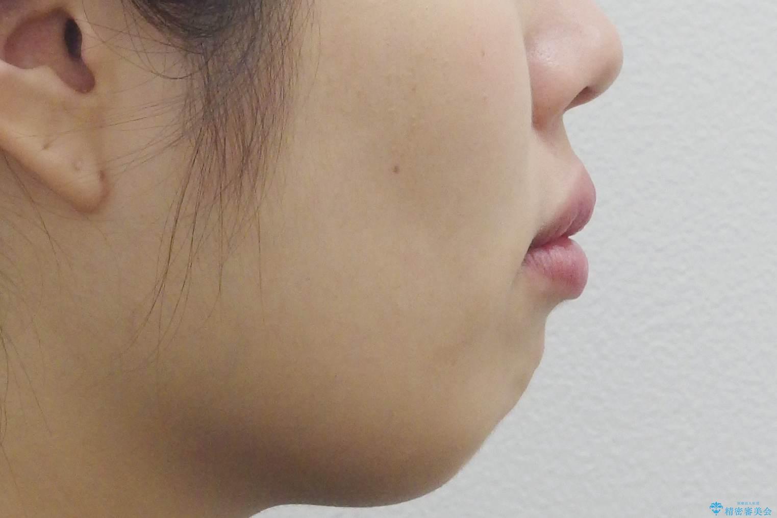ガタつきと口元の改善 抜歯を伴うワイヤー矯正の治療前(顔貌)
