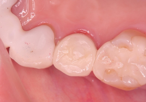 歯が折れている(1DAY インプラント)の治療後