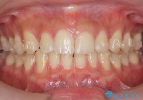 すきっ歯 セラミックで治すか矯正で治すか相談したいの治療中