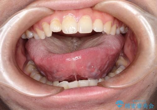 滑舌の向上を目指して! 舌小帯形成術の効果を実感しようの症例 治療前