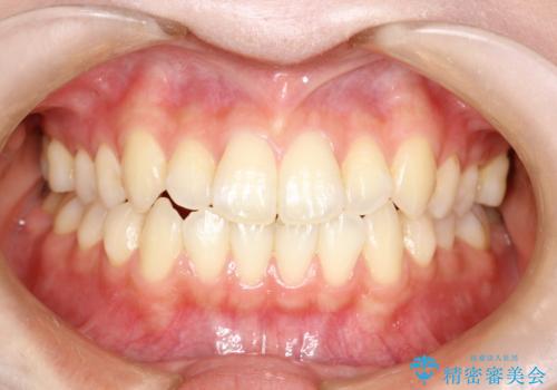 前歯のガタつき、下顎の前突感を治したい　インビザライン矯正例の症例 治療前