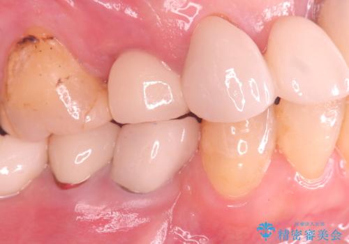 歯が折れている(1DAY インプラント)の症例 治療後