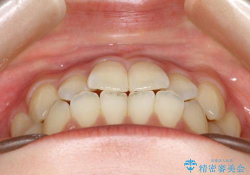 前歯のガタつき、下顎の前突感を治したい インビザライン矯正例の治療前
