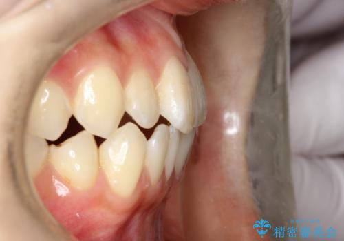 前歯のガタつき、下顎の前突感を治したい インビザライン矯正例の治療前