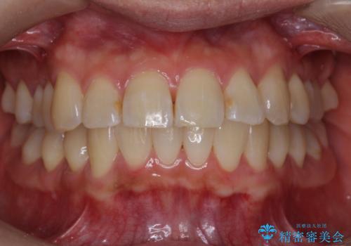 前歯と奥歯の反対咬合　部分ワイヤーとインビザラインでの治療後