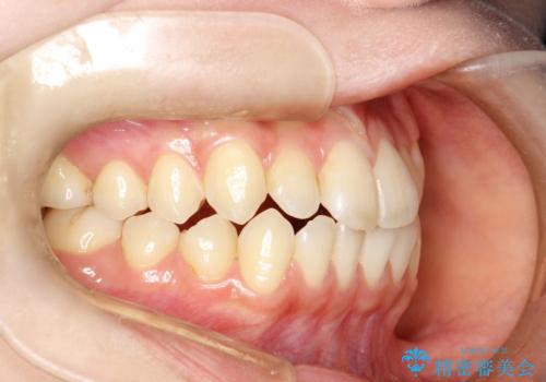 前歯のガタつき、下顎の前突感を治したい インビザライン矯正例の治療前