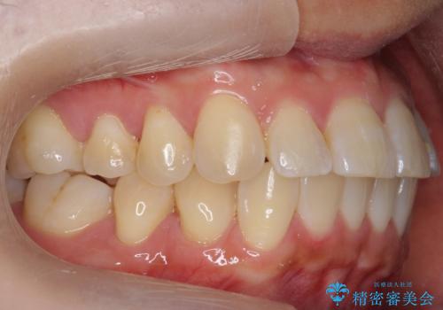 前歯と奥歯の反対咬合 部分ワイヤーとインビザラインでの治療後