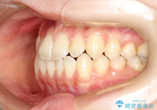 前歯のガタつき、下顎の前突感を治したい インビザライン矯正例の治療前