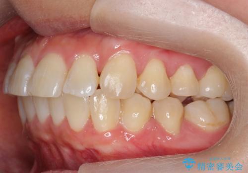 前歯と奥歯の反対咬合　部分ワイヤーとインビザラインでの治療後