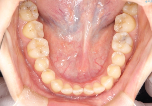 前歯のガタつき、下顎の前突感を治したい インビザライン矯正例の治療前