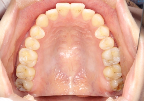 前歯のガタつき、下顎の前突感を治したい　インビザライン矯正例の治療前