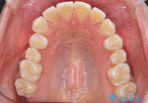 前歯と奥歯の反対咬合 部分ワイヤーとインビザラインでの治療後
