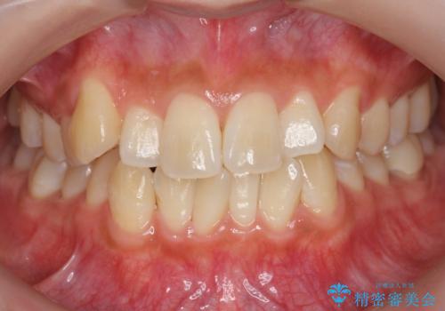 八重歯をインビザラインで　抜歯矯正の治療前