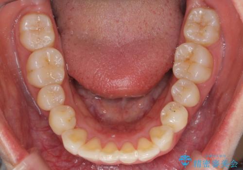 前歯と奥歯の反対咬合 部分ワイヤーとインビザラインでの治療後