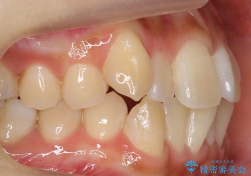 八重歯をインビザラインで 抜歯矯正の治療前