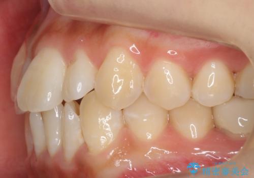 八重歯 インビザラインで抜歯矯正 ただし1本のみの抜歯で済みますの治療前