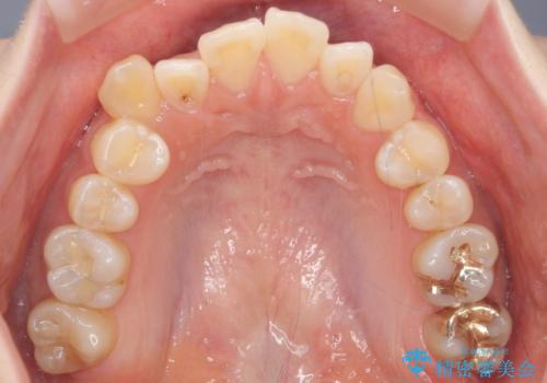 八重歯 インビザラインで抜歯矯正 ただし1本のみの抜歯で済みますの治療前