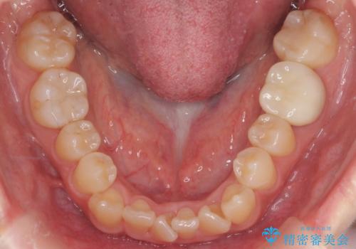 八重歯　インビザラインで抜歯矯正　ただし1本のみの抜歯で済みますの治療前