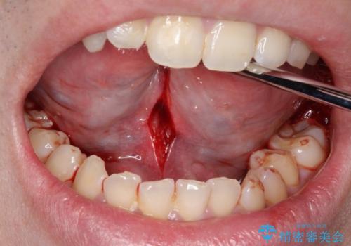 滑舌の向上を目指して! 舌小帯形成術の効果を実感しようの治療中