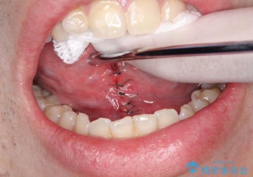 滑舌の向上を目指して! 舌小帯形成術の効果を実感しようの治療中