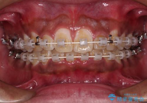 上顎前突とディープバイト ワイヤー矯正での確実に仕上げるの治療中
