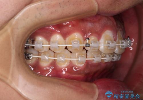 上顎前突とディープバイト ワイヤー矯正での確実に仕上げるの治療中