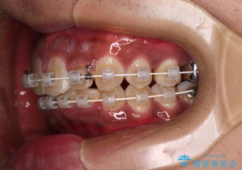 上顎前突とディープバイト ワイヤー矯正での確実に仕上げるの治療中