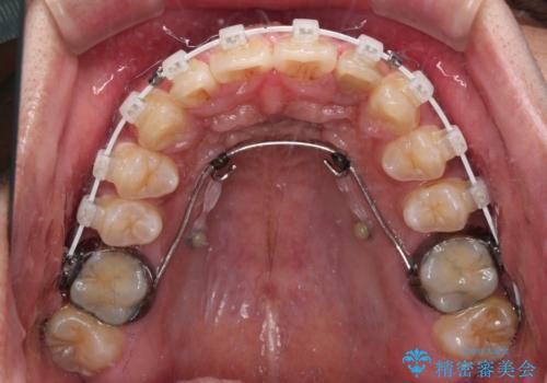 上顎前突とディープバイト ワイヤー矯正での確実に仕上げるの治療中