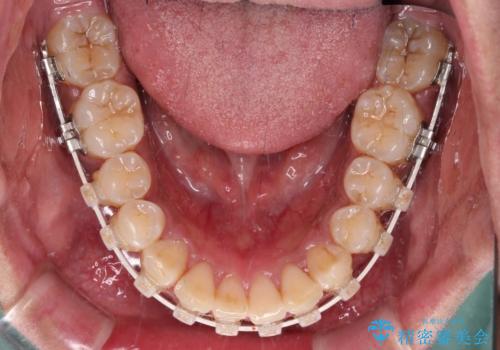 上顎前突とディープバイト ワイヤー矯正での確実に仕上げるの治療中