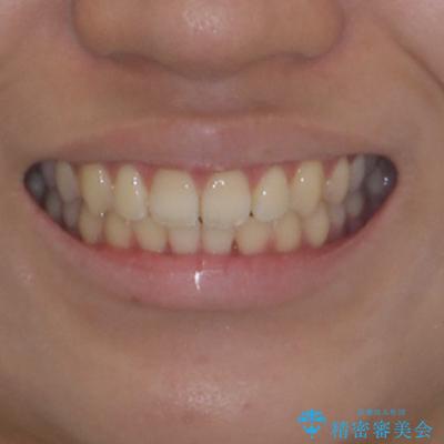 デコボコをワイヤー装置で改善 短期間で綺麗な仕上がりにの治療後(顔貌)