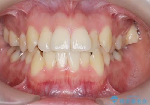前歯のがたつき　すれ違い咬合のマウスピース矯正治療の治療前