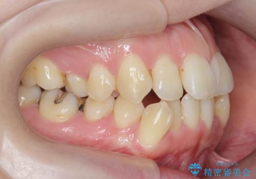 前歯のがたつき すれ違い咬合のマウスピース矯正治療の治療前