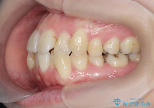 前歯のがたつき　すれ違い咬合のマウスピース矯正治療の治療前