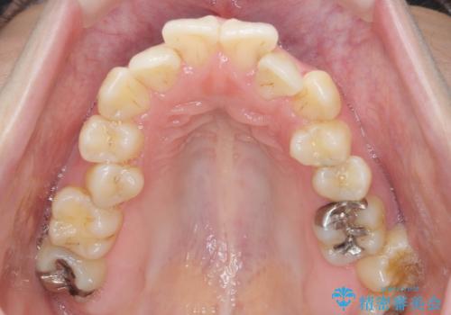 前歯のがたつき すれ違い咬合のマウスピース矯正治療の治療前