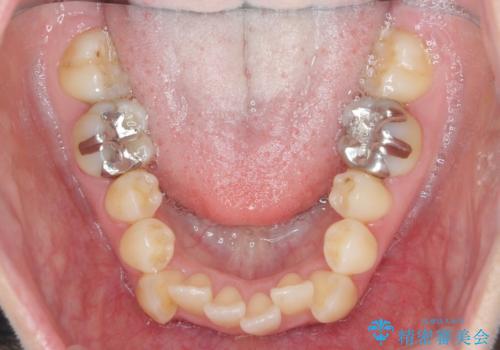 前歯のがたつき すれ違い咬合のマウスピース矯正治療の治療前