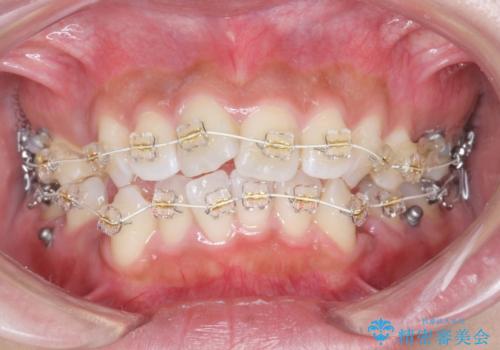 ガタつきと口元の改善　抜歯を伴うワイヤー矯正の治療前