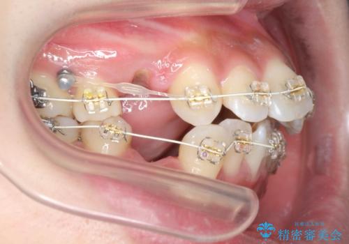 ガタつきと口元の改善　抜歯を伴うワイヤー矯正の治療前