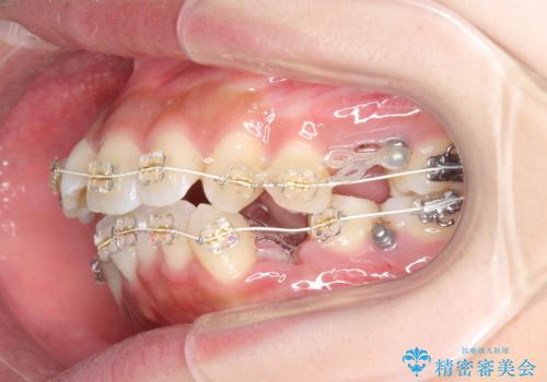 ガタつきと口元の改善 抜歯を伴うワイヤー矯正の治療前
