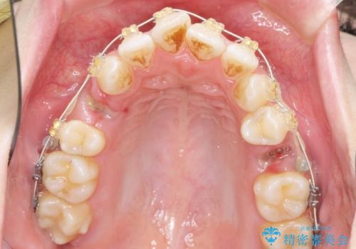 ガタつきと口元の改善 抜歯を伴うワイヤー矯正の治療前