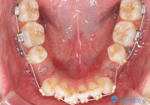 ガタつきと口元の改善 抜歯を伴うワイヤー矯正の治療前