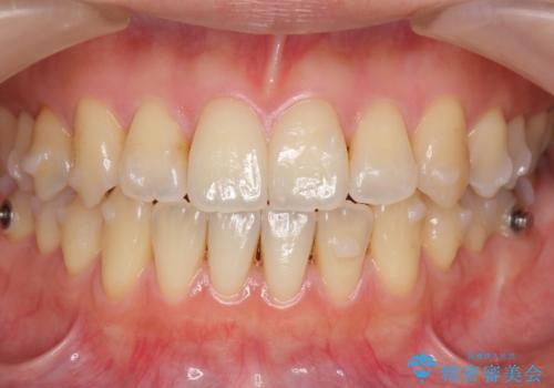 前歯のがたつき 若干受け口 インビザラインでの治療中