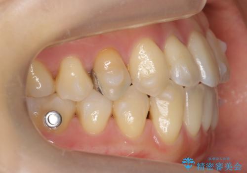 前歯のがたつき 若干受け口 インビザラインでの治療中