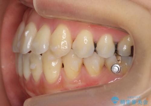 前歯のがたつき 若干受け口 インビザラインでの治療中