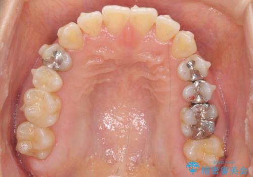 前歯のがたつき 若干受け口 インビザラインでの治療中