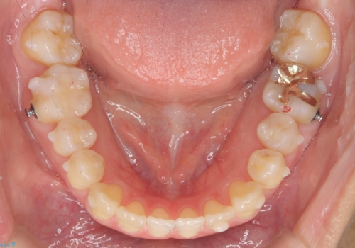 前歯のがたつき 若干受け口 インビザラインでの治療中