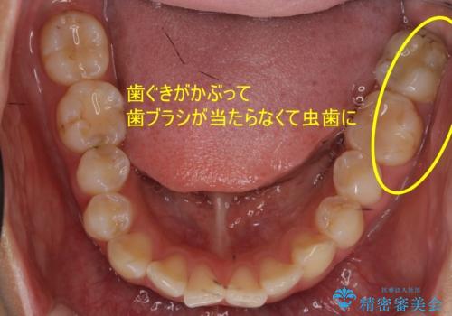 保険治療のプラスチックが劣化し虫歯に。 セラミックでつぎはぎなく治療の症例 治療前