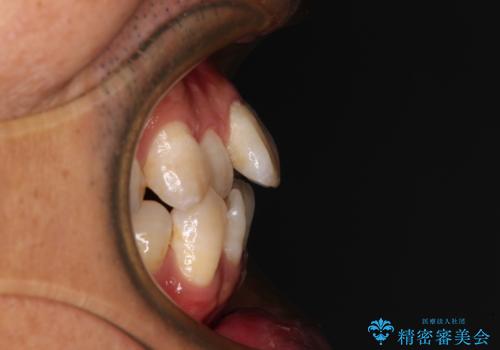 40代男性 今からでも遅くない インビザラインで綺麗な歯列を獲得の治療前