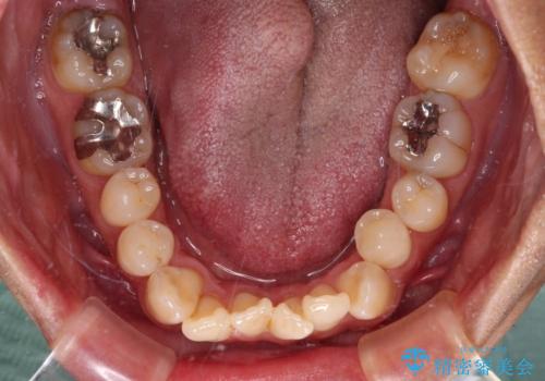 40代男性 今からでも遅くない インビザラインで綺麗な歯列を獲得の治療前