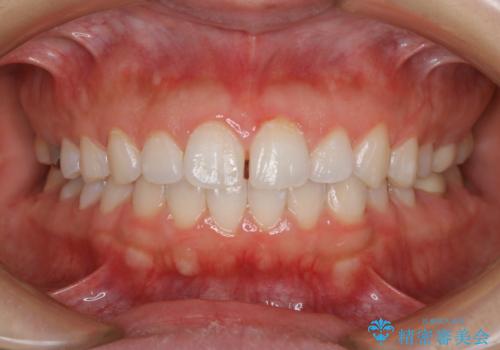 NEW ティオンオフィスホワイトニング(処置前クリーニング込)の治療後